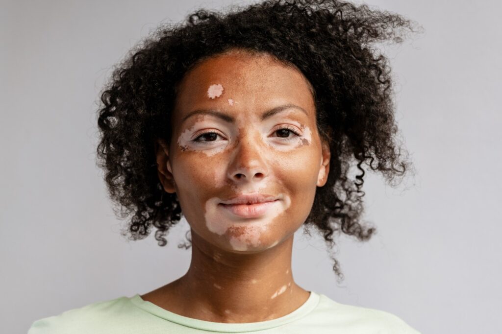 Young woman with skin condition vitiligo